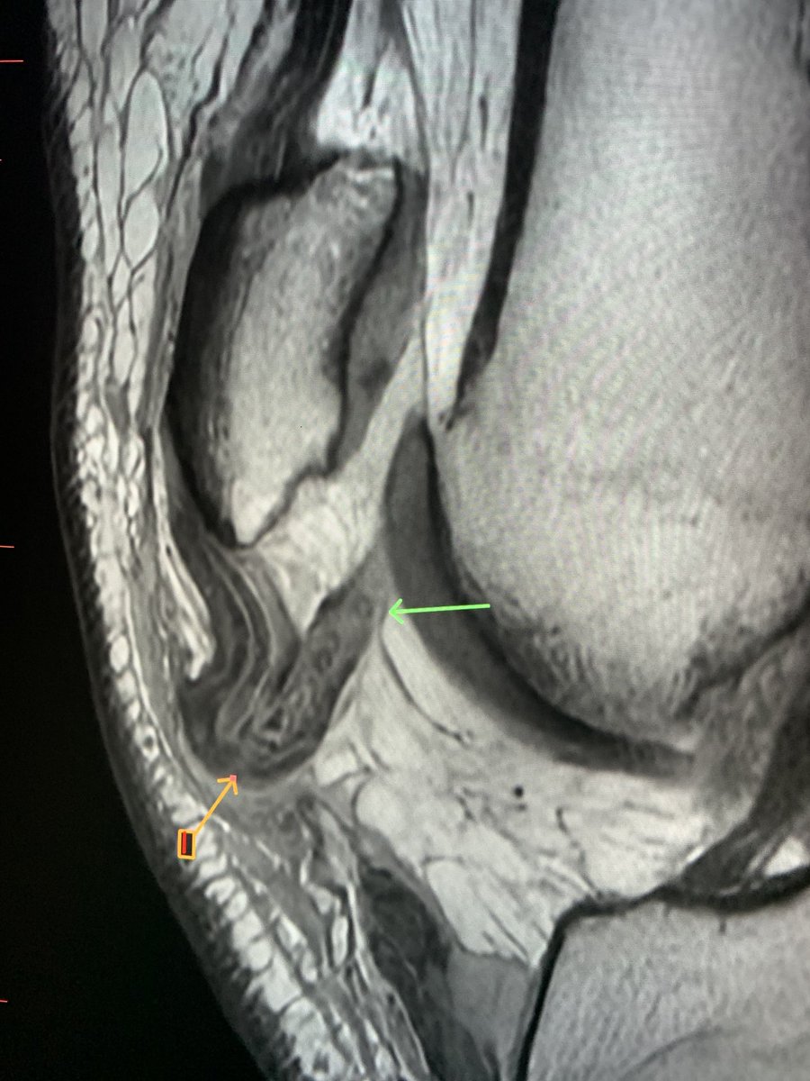 northwoods1980's tweet photo. Normal versus not. Am I the only one who thinks soft tissues are often under assessed by all of us on radiographs at times? I know I often don't pay enough attention. https://t.co/0R7IM9pMw8