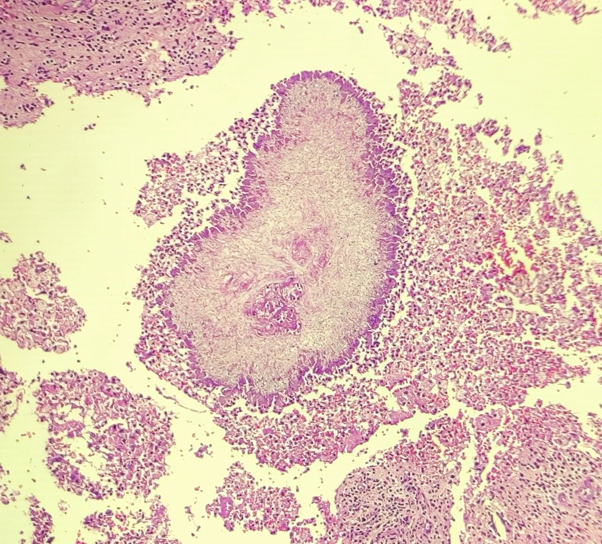 msnsayed14's tweet image. Splendore Hoeppli phenomenon
#PathTwitter #pathology #pathtwt