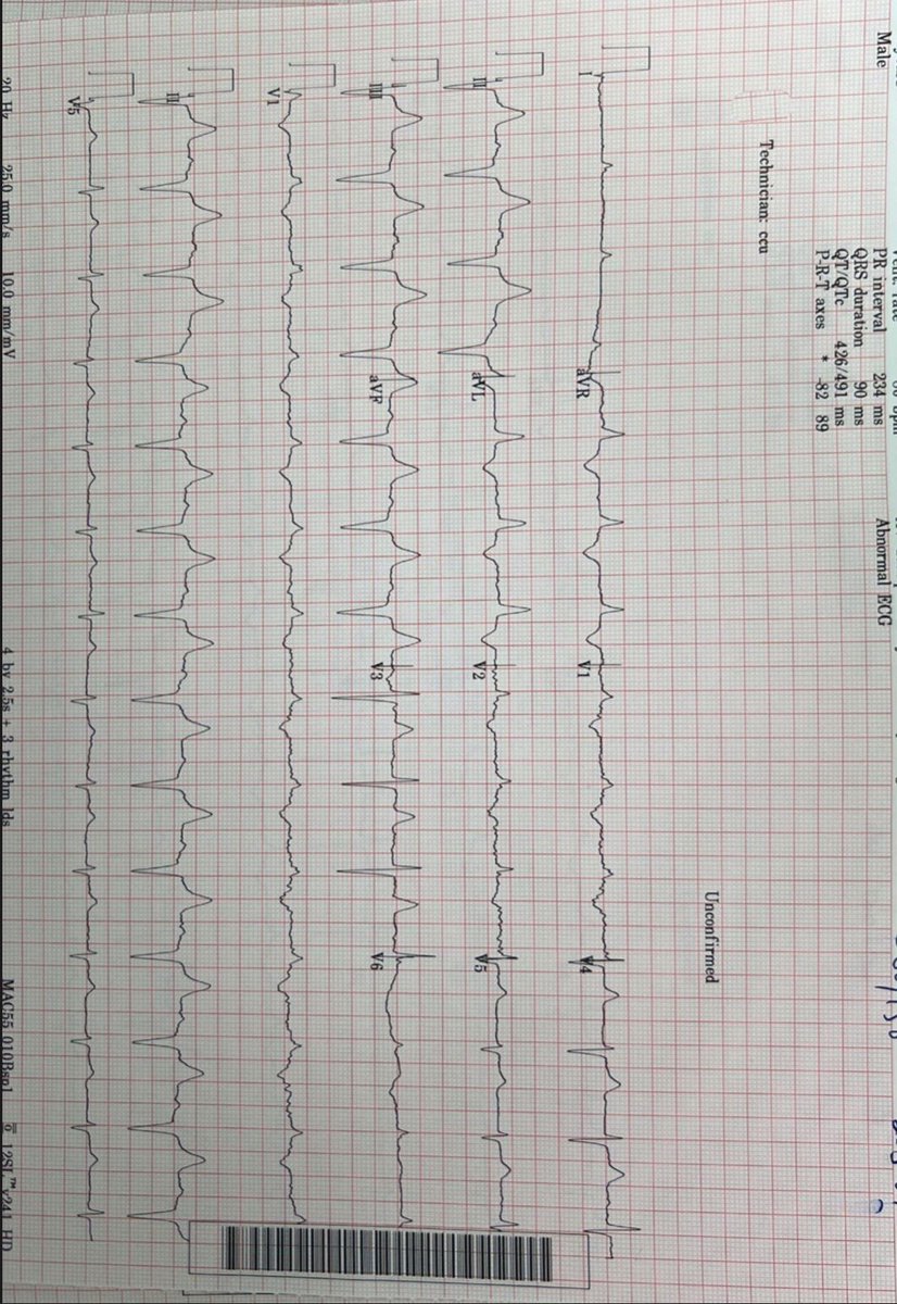 #LBBP : 

Left bundle branch pacing is a novel pacing modality that can bypass the pathological or disease-vulnerable region in the cardiac conduction system, to provide physiological pacing modality for patients. LBBP guarantees a narrow paced QRS complex.