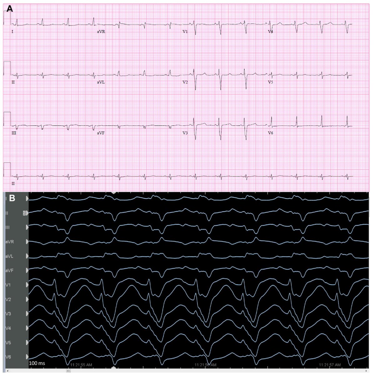 Heart Rhythm Case Reports tweet media