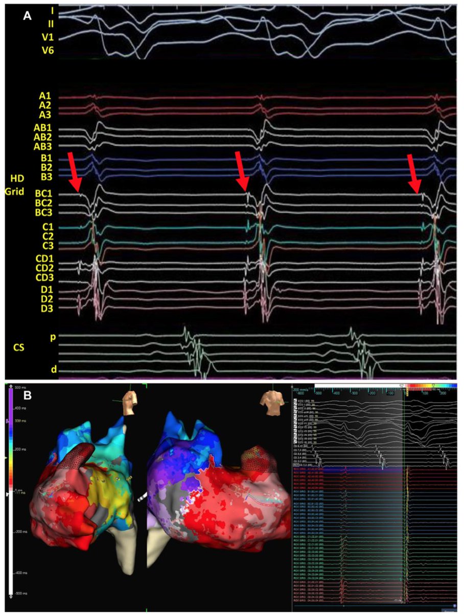 Heart Rhythm Case Reports tweet media