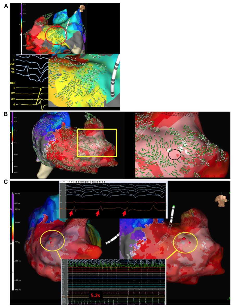Open-window mapping of atriofascicular tachycardia heartrhythmcasereports.com/article/S2214-…