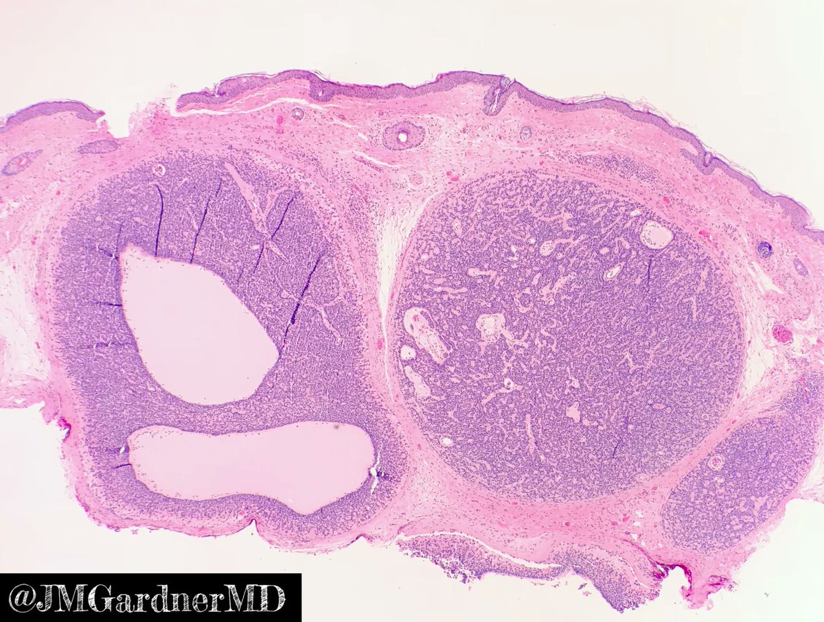 JMGardnerMD's tweet image. Skin nodule. Your diagnosis? Answer: kikoxp.com/posts/10372. Video: kikoxp.com/posts/4179 #pathology #pathologists #pathTwitter #dermpath #dermatology #dermtwitter #dermatologia