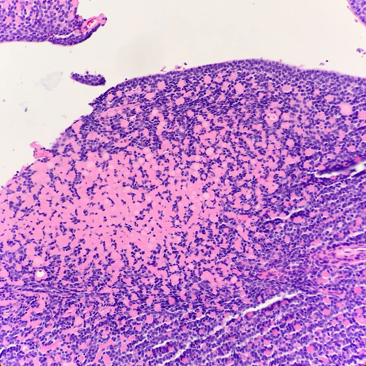 JMGardnerMD's tweet image. Skin nodule. Your diagnosis? Answer: kikoxp.com/posts/10372. Video: kikoxp.com/posts/4179 #pathology #pathologists #pathTwitter #dermpath #dermatology #dermtwitter #dermatologia
