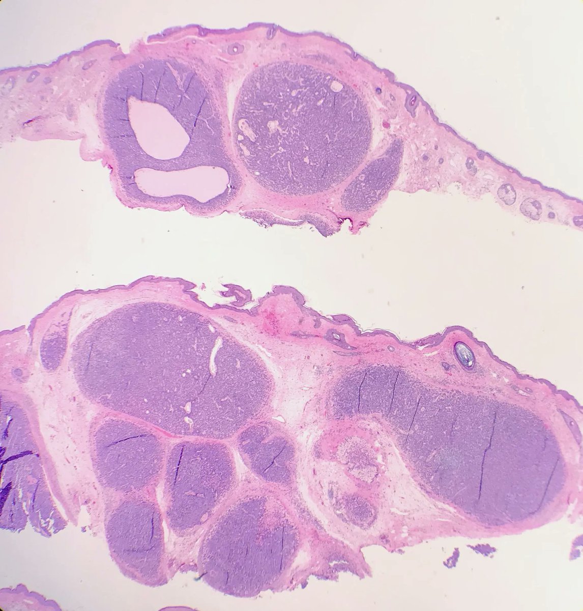 JMGardnerMD's tweet image. Skin nodule. Your diagnosis? Answer: kikoxp.com/posts/10372. Video: kikoxp.com/posts/4179 #pathology #pathologists #pathTwitter #dermpath #dermatology #dermtwitter #dermatologia