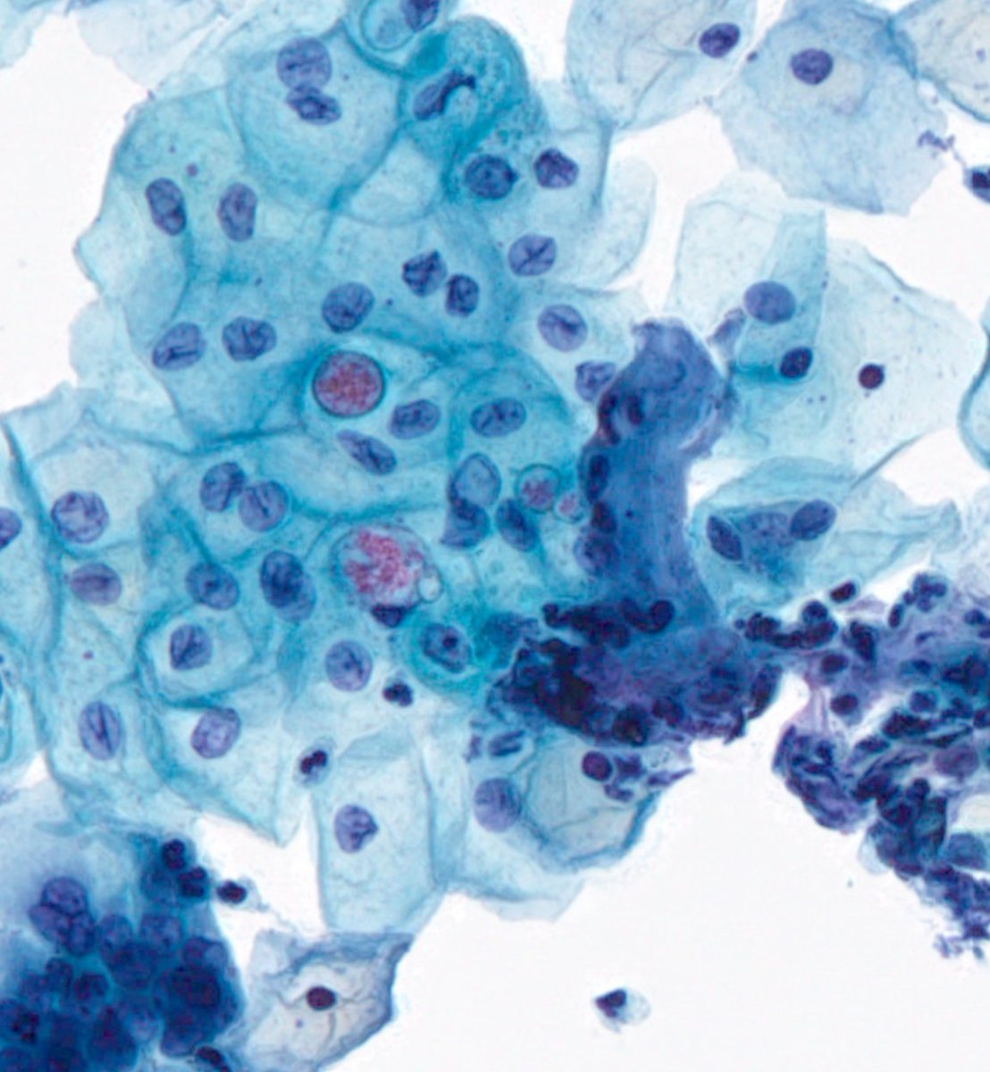 JMatthieu_Path's tweet photo. #PathBug Case
What do you think about this ? Cervical #Cytology Bug or Artefact ? Amoebae ? #GynPath @ParasiteGal 
🙏🙏🙏 https://t.co/pWHv9dGH1x