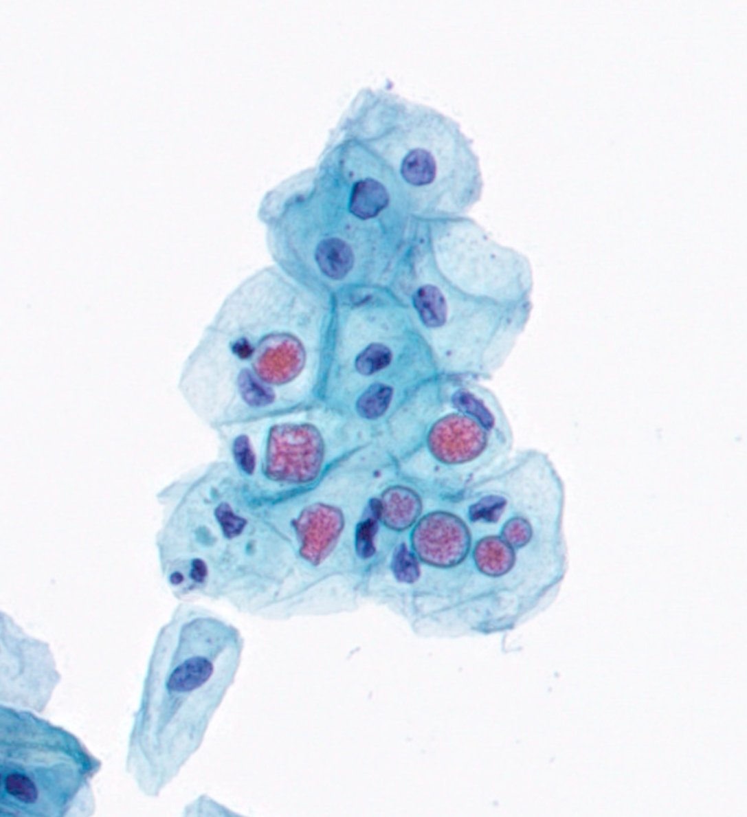 JMatthieu_Path's tweet photo. #PathBug Case
What do you think about this ? Cervical #Cytology Bug or Artefact ? Amoebae ? #GynPath @ParasiteGal 
🙏🙏🙏 https://t.co/pWHv9dGH1x