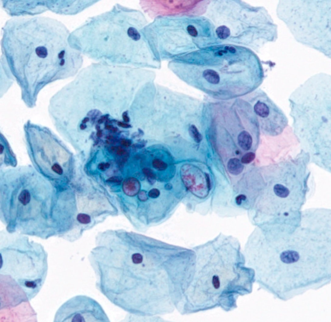 JMatthieu_Path's tweet photo. #PathBug Case
What do you think about this ? Cervical #Cytology Bug or Artefact ? Amoebae ? #GynPath @ParasiteGal 
🙏🙏🙏 https://t.co/pWHv9dGH1x