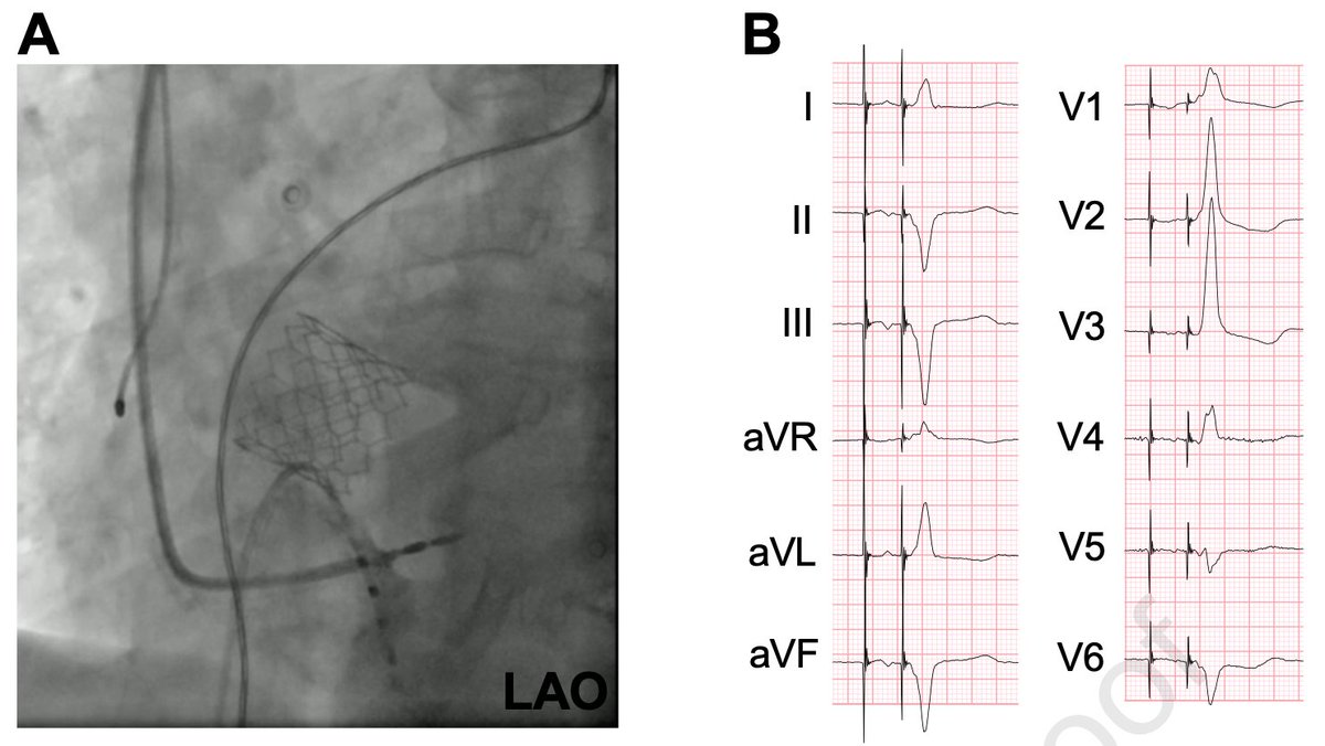 Early sudden distal conductor fracture of a stylet-driven lead implanted for left bundle branch area pacing heartrhythmcasereports.com/article/S2214-…