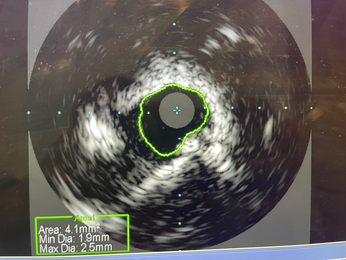csandhuMD's tweet photo. 75 yo M admitted for NSTEMI EF now 27%, CKD stage 4,active smoker with severe COPD and not surgical candidate.  RCA CTO w/collaterals from left.  Whats your approach? IVUS of distal LMCA. Support use? @mandeep_mayo @DrJayMohan @adityadoc1 https://t.co/4By7nCA0Vp