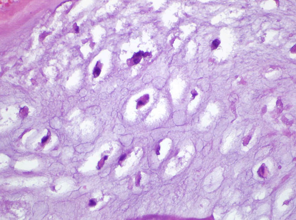 Scapular mass- Grade I, Chondrosarcoma 🦴🦴 #PathTwitter #MedTwitter #BoneAndSoftTissue