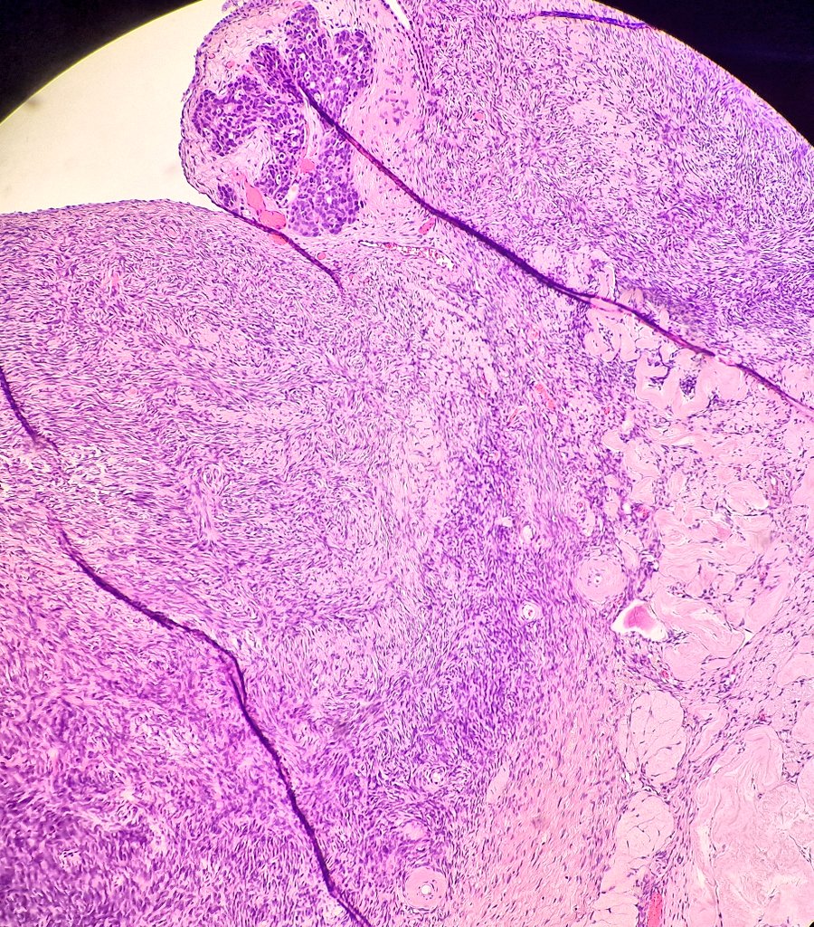DrAlessandroIac's tweet photo. high grade serous carcinoma implant on controlateral ovary
#gynpath #path #pathology #iapath #highgradeserouscarcinoma #hgsc #ovarianpathology #ovarica #patologiaovarica #ovary #ovariancancer #iarc #gyncancer #surgicalpathology https://t.co/byu0WwHbQq