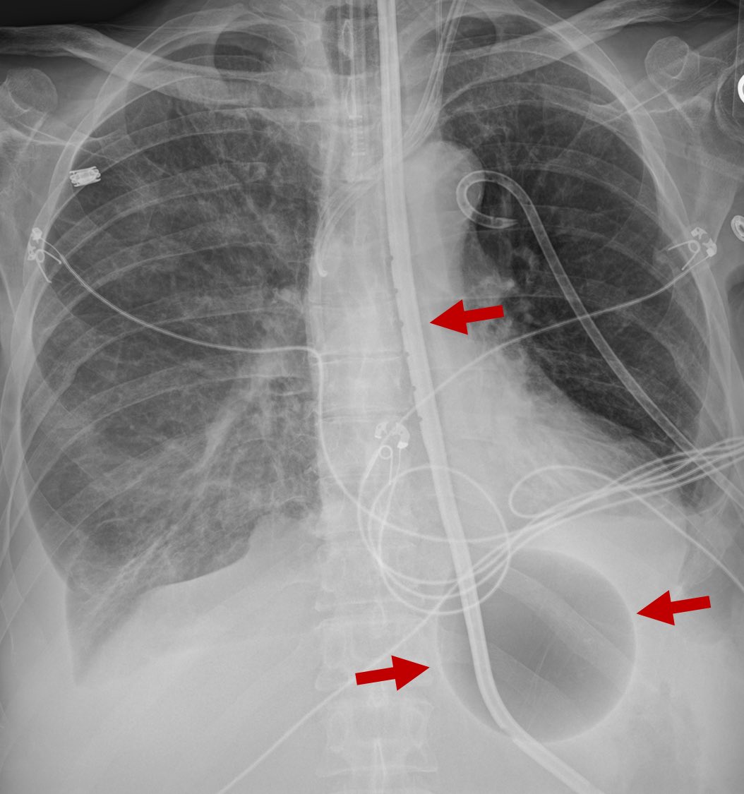 This is a blakemore tube. A sengstaken-blakemore tube. 

It’s used to tamponade UGI hemorrhage due to varices in emergency situations. 

Notice the large air bubble that’s been insufflated to tamponade those bleeders