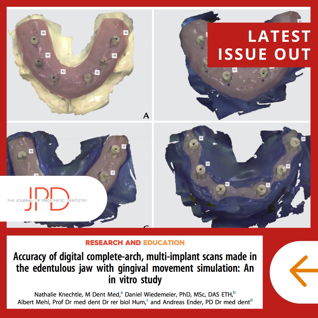 JPDentistry's tweet photo. This week we highlight articles from the latest issue of #theJPD. This #invitrostudy compares the effect of #gingivaltissue anatomy when using conventional analog versus #digitaldentistry workflows when making an #implantimpression. Learn more: https://t.co/nvmspoK6tH https://t.co/9cj13NBPY3