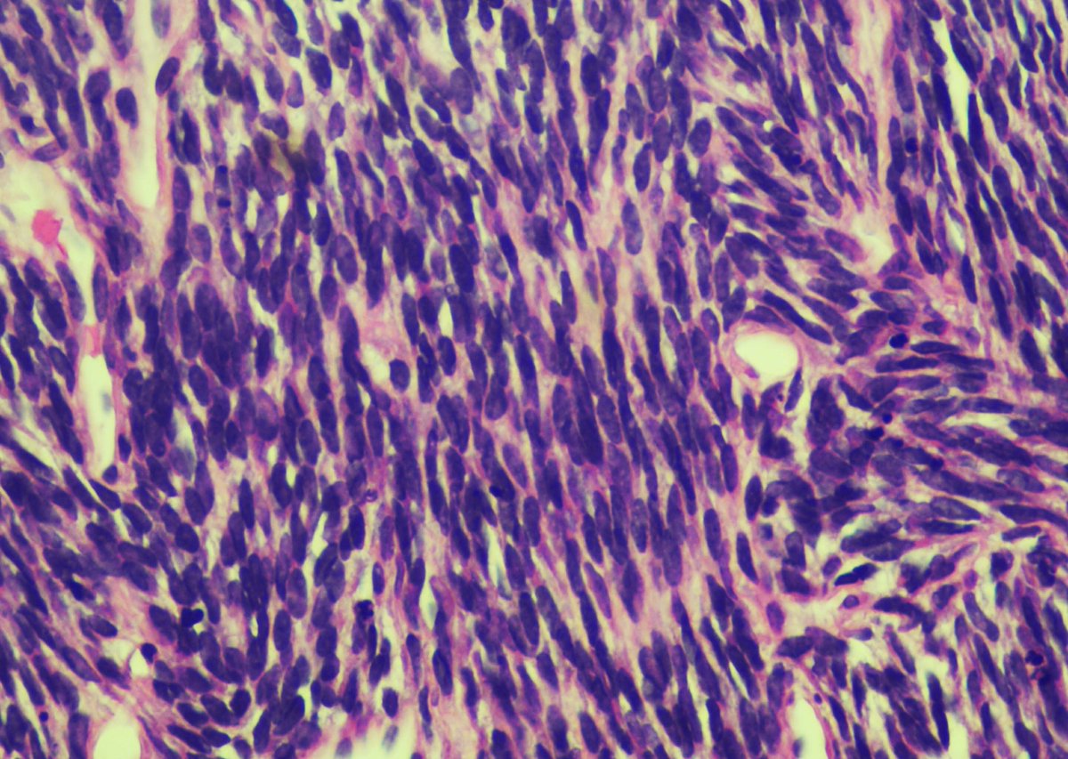 philly_path's tweet photo. Case of the week!
25 year old female, no past medical history, 10cm left thoracic mass. Thoughts? Differential diagnosis?
#pathology #bstpathology #PathTwitter https://t.co/psK9sA3WrC
