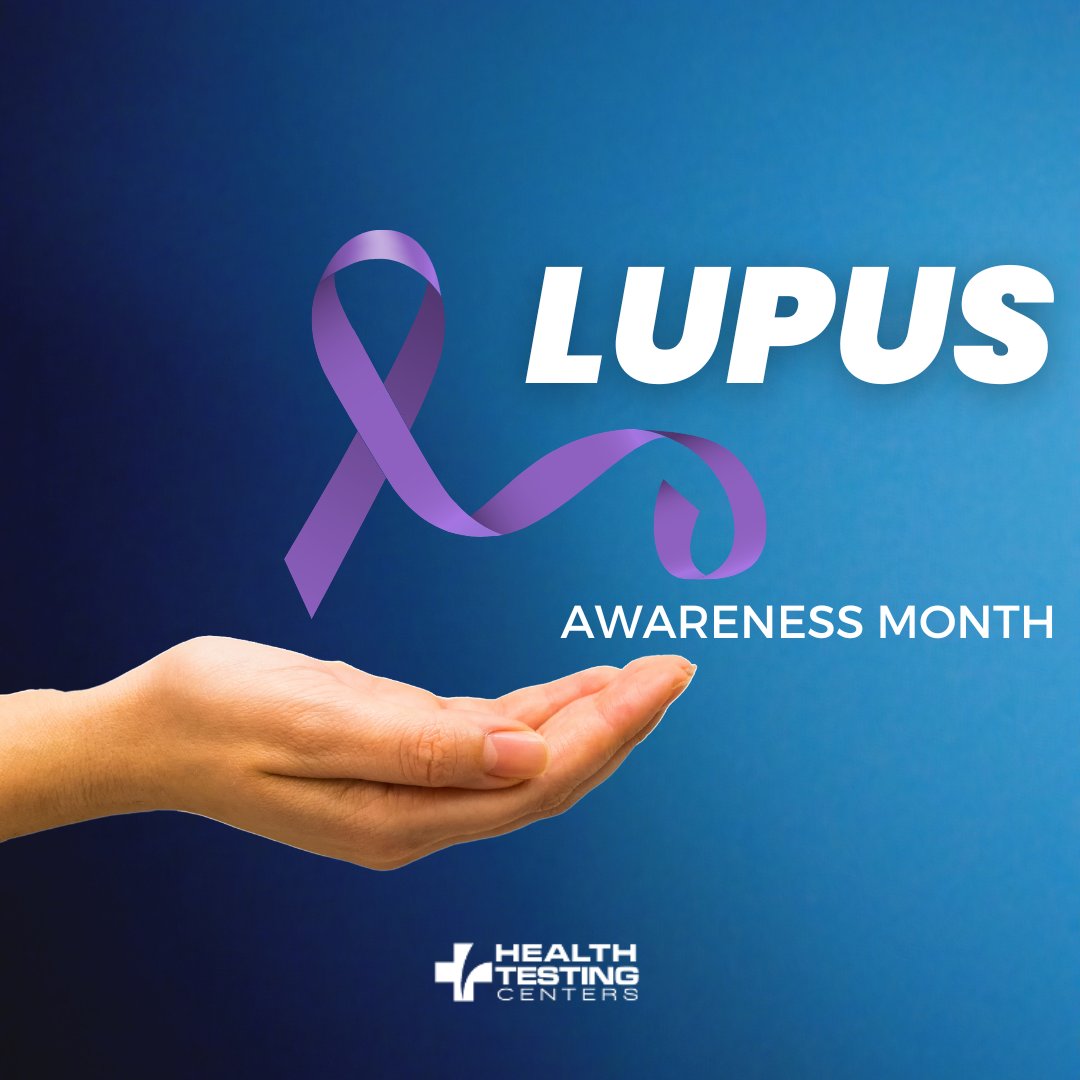 bloodtesting's tweet photo. Lupus is an autoimmune disease in which the immune system attacks its own tissues causing widespread inflammation and tissue damage in the affected organs.The Anti-dsDNA Blood Test may be used to help detect lupus in an individual who has had a positive antinuclear antibody test. https://t.co/BHEMBrcMJz