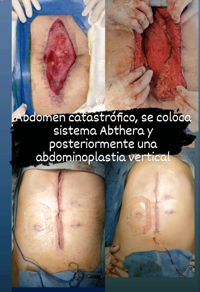 jimmybarrera172's tweet photo. La magia del VAC.
Paciente con múltiples intervenciones quirúrgicas por HPAF, se dio manejo del abdomen abierto con sistema Abthera. Después de varios recambios se pudo cerrar. 
#surgery #abthera #MedTwitter 
#VAC https://t.co/p90XSfq5AI