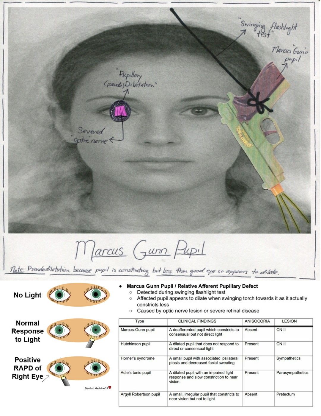 Marcus Gunn Pupil Reflex Marcus Gunn Pupil What Is It Causes marcus-gunn-pupil-reflex-marcus-gunn-pupil-what-is-it-causes