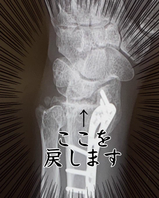 [ご報告]

来月の手術が決まりました。
手術は11/16(水)
去年入れたプレート抜釘と
左手橈骨遠位端の陥没を解消して
手首を元の位置に戻します。

さっき手術前検査もやって
採血めっちゃ採りました()

がんばるで!!!! 