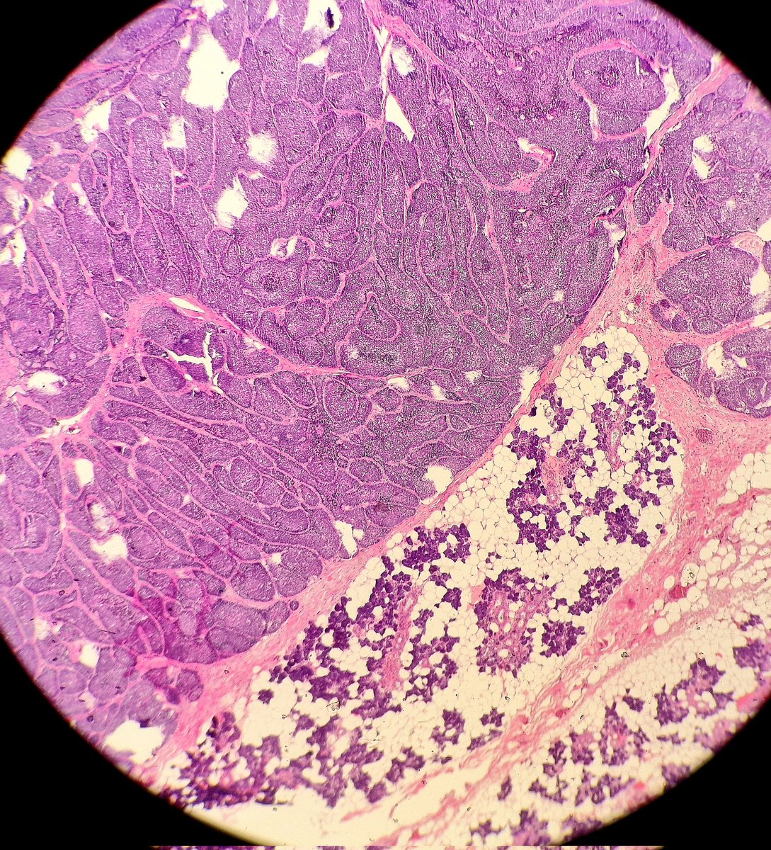 DrAlessandroIac's tweet photo. Basal Cell Adenoma of the Parotid gland
#parotid #adenoma #basalcell #glands #salivaryglands #salivaryglandspath #path #pathologist #pathology #patologia #oncologia #medicine #iapath #parotidadenoma #lesion #benignlesion #tumor #med #anatomiapatologica https://t.co/PdXGs9J4TN