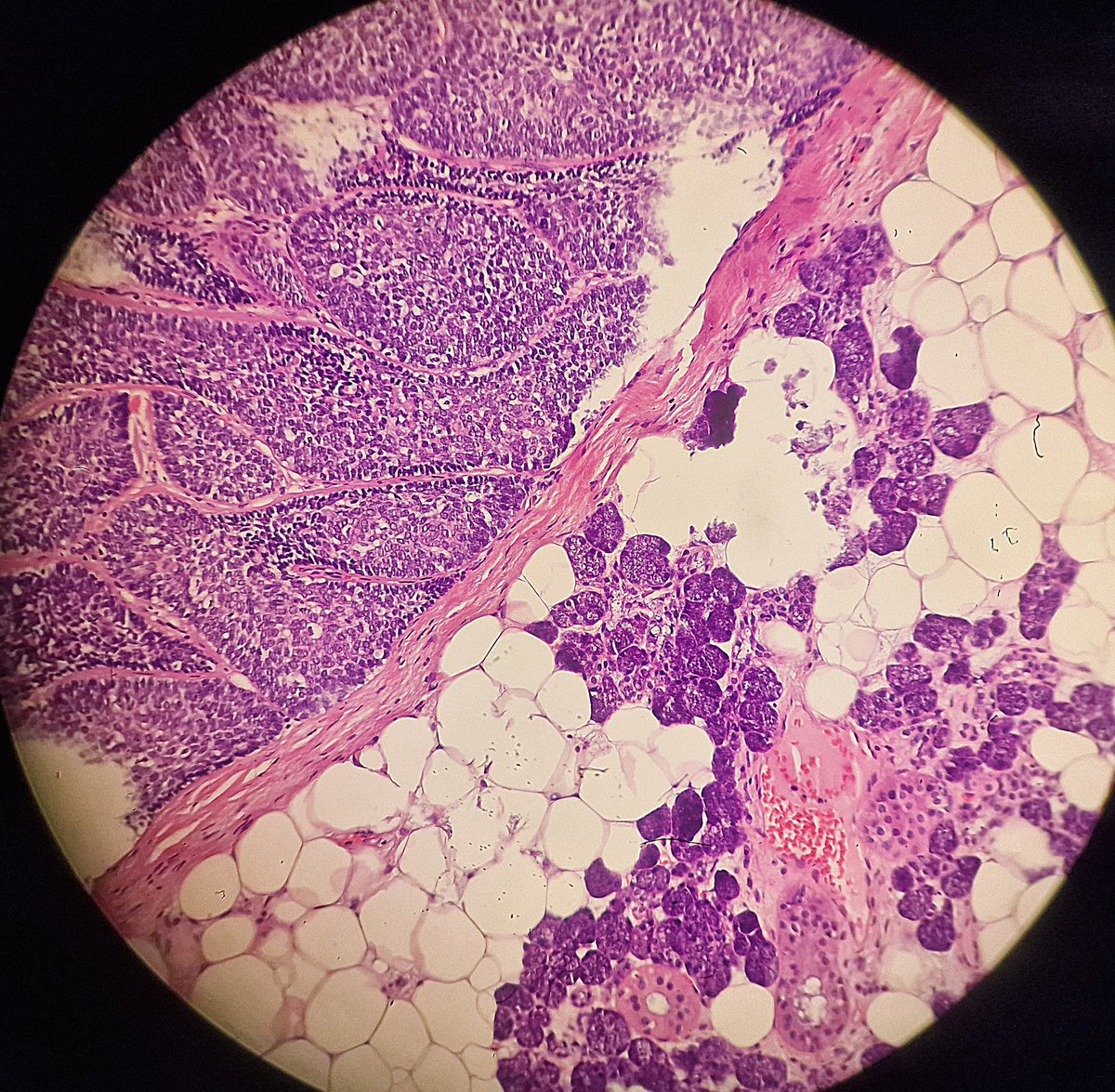 DrAlessandroIac's tweet photo. Basal Cell Adenoma of the Parotid gland
#parotid #adenoma #basalcell #glands #salivaryglands #salivaryglandspath #path #pathologist #pathology #patologia #oncologia #medicine #iapath #parotidadenoma #lesion #benignlesion #tumor #med #anatomiapatologica https://t.co/PdXGs9J4TN