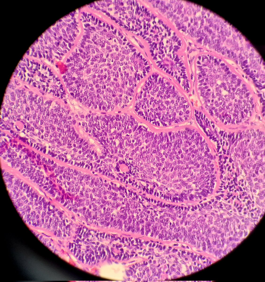 DrAlessandroIac's tweet photo. Basal Cell Adenoma of the Parotid gland
#parotid #adenoma #basalcell #glands #salivaryglands #salivaryglandspath #path #pathologist #pathology #patologia #oncologia #medicine #iapath #parotidadenoma #lesion #benignlesion #tumor #med #anatomiapatologica https://t.co/PdXGs9J4TN