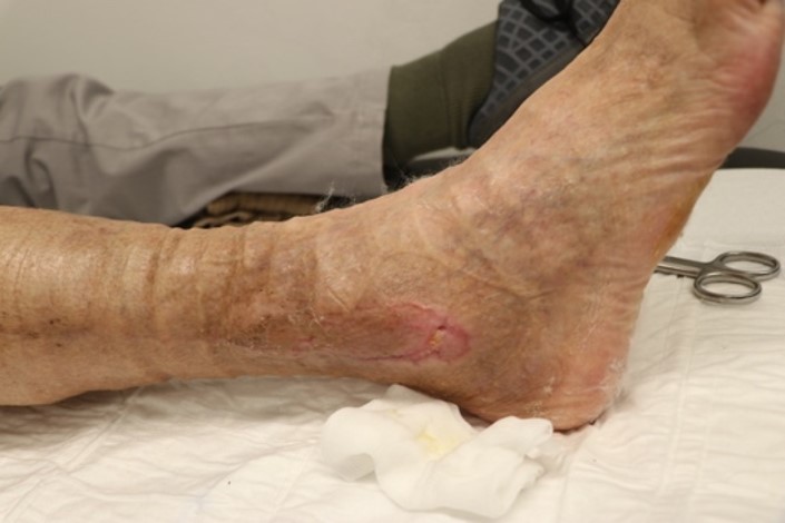 coldplasmatech's tweet image. Hier eine Patientin mit &quot;Bisgaardscher Kulisse&quot; und zurückgehender Spalthaut. Eine Wunde, die bei konventioneller Behandlung unheilbar erschien, konnten wir mit dem CPTpatch verschließen. Nach 13 Behandlungen konnte die #chronischewunde nachhaltig geschlossen werden.