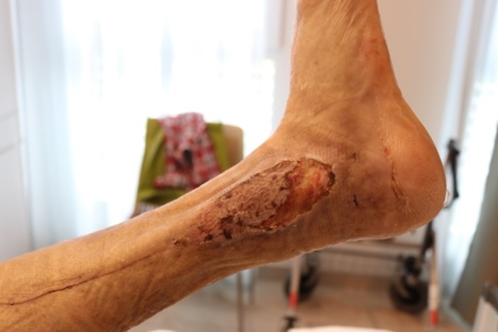 coldplasmatech's tweet image. Hier eine Patientin mit &quot;Bisgaardscher Kulisse&quot; und zurückgehender Spalthaut. Eine Wunde, die bei konventioneller Behandlung unheilbar erschien, konnten wir mit dem CPTpatch verschließen. Nach 13 Behandlungen konnte die #chronischewunde nachhaltig geschlossen werden.