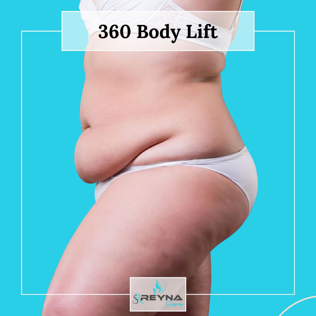 reyna_surgery's tweet photo. 360 Body Lift - 360 Karın germe

Jetzt ist die Zeit für dich-Şimdi zaman senin 🍀

 #bauchdeckenstraffung #istanbul #tummytuck #karingerme #abdominoplasty #fullkaringerme #fullkaringerme #minikaringerme #liposuction #360karingerme #360abdominolasty #köln #Fenerbahce https://t.co/YkORYD3BJH