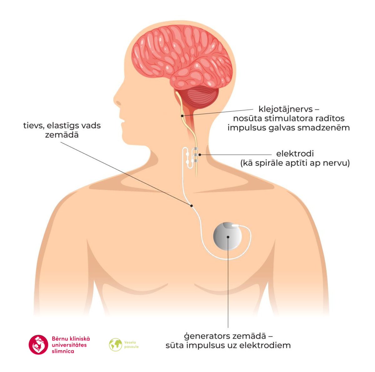 Labas ziņas! 🥳 Bērnu slimnīcā oktobra sākumā veiksmīgi noritējušas pirmās trīs no valsts budžeta apmaksātās operācijas, lai uzsāktu klejotājnerva stimulācijas terapiju bērniem, kuri cieš no epilepsijas lēkmēm. bkus.lv/lv/content/ber…