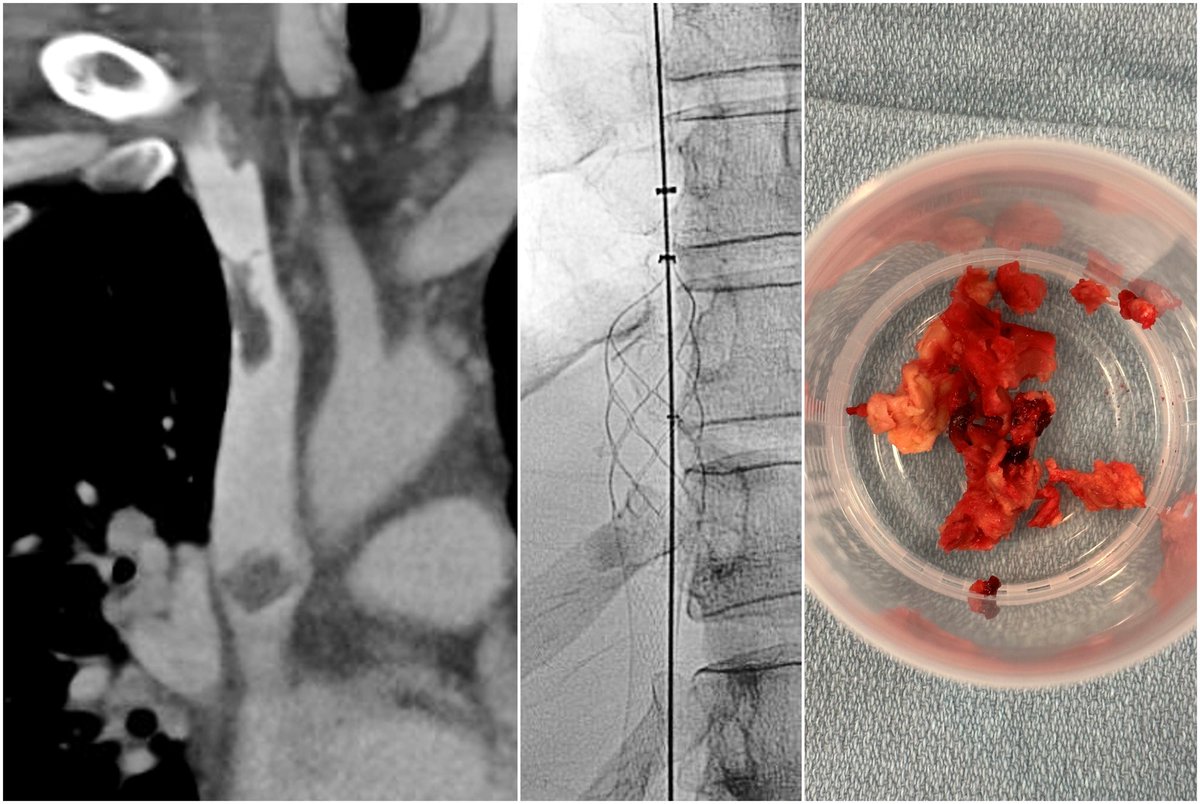 Jeffrey F. B. Chick, MD, MPH (@chickvir) on Twitter photo Venous thrombectomy allows for the removal infected thrombus, vegetations, and debris and allows for the clearance of persistent bacteremia. <a href="/InariMedical/">Inari, now part of Stryker</a> <a href="/UofWa_IR/">University of Washington IR Residency</a> <a href="/UWRadiology/">UW Radiology</a> <a href="/SIRRFS/">SIR RFS</a> <a href="/SIR_ECS/">SIR ECS</a> <a href="/SIRspecialists/">Society of Interventional Radiology</a> <a href="/cirsesociety/">CIRSE</a> Venous thrombectomy allows for the removal infected thrombus, vegetations, and debris and allows for the clearance of persistent bacteremia. <a href="/InariMedical/">Inari, now part of Stryker</a> <a href="/UofWa_IR/">University of Washington IR Residency</a> <a href="/UWRadiology/">UW Radiology</a> <a href="/SIRRFS/">SIR RFS</a> <a href="/SIR_ECS/">SIR ECS</a> <a href="/SIRspecialists/">Society of Interventional Radiology</a> <a href="/cirsesociety/">CIRSE</a>