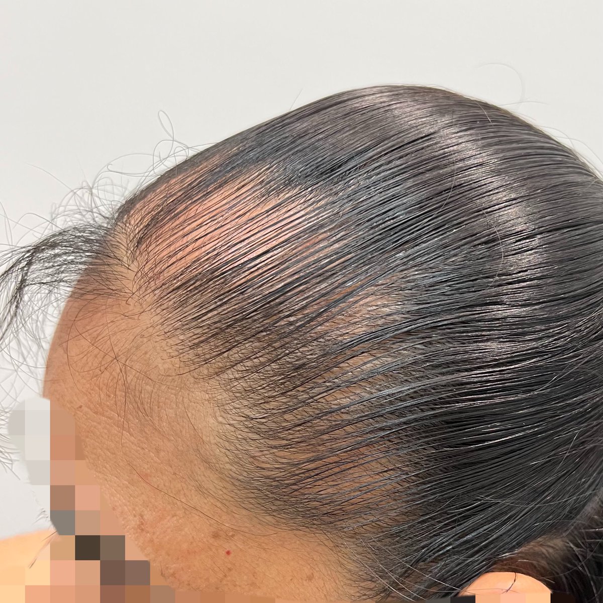 Dr_Llibran's tweet photo. Alopecia por tracción, se van perdiendo poco poco los folículos pilosos debido a la tracción constante. Los folículos “se cansan” de caer y regenerarse y llega el punto en que se crea una cicatriz y se pierde para siempre. 

Eviten usar su cabello muy “jalado” https://t.co/KHfuMkwAbO