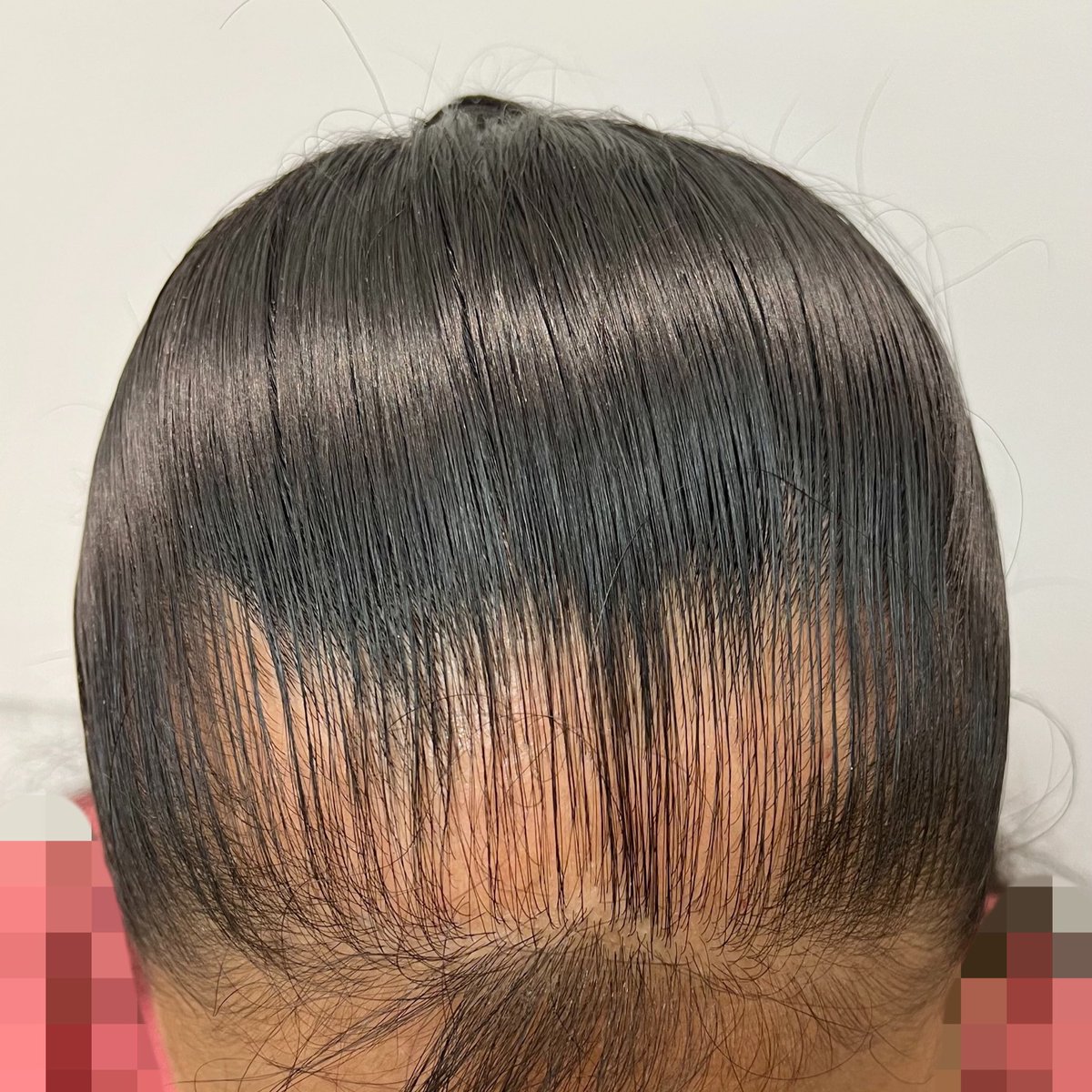 Dr_Llibran's tweet photo. Alopecia por tracción, se van perdiendo poco poco los folículos pilosos debido a la tracción constante. Los folículos “se cansan” de caer y regenerarse y llega el punto en que se crea una cicatriz y se pierde para siempre. 

Eviten usar su cabello muy “jalado” https://t.co/KHfuMkwAbO