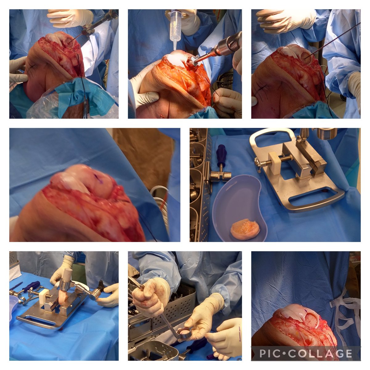 mjgrant87's tweet photo. Another day..another Osteochondral Allograft. Another one lined up in a couple of weeks! #savethejoint #sportssurgery #perthsportssurgeryfellowship #conmed #orthotwitter https://t.co/s442figYo6
