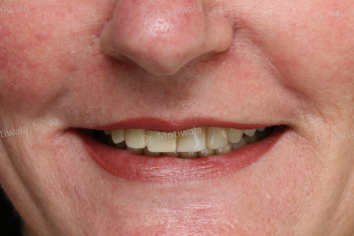 drmotiwaladcic's tweet image. Missing #frontteeth replacement with single piece #basalimplant 
A missing front tooth in the front esthetic region is always a major concern whether or not there is a pain. Such teeth can easily be replaced with #immediateloading single piece implants.
#Hyderabad #India #USA