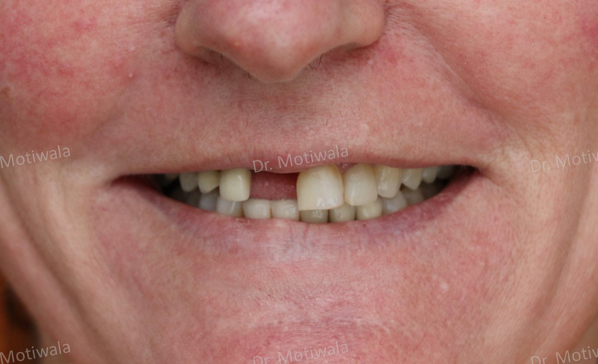drmotiwaladcic's tweet image. Missing #frontteeth replacement with single piece #basalimplant 
A missing front tooth in the front esthetic region is always a major concern whether or not there is a pain. Such teeth can easily be replaced with #immediateloading single piece implants.
#Hyderabad #India #USA