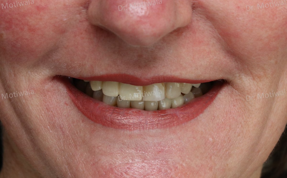 drmotiwaladcic's tweet image. Missing #frontteeth replacement with single piece #basalimplant 
A missing front tooth in the front esthetic region is always a major concern whether or not there is a pain. Such teeth can easily be replaced with #immediateloading single piece implants.
#Hyderabad #India #USA