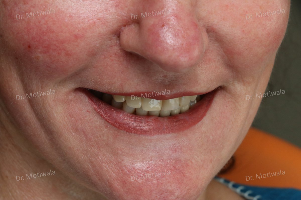 drmotiwaladcic's tweet image. Missing #frontteeth replacement with single piece #basalimplant 
A missing front tooth in the front esthetic region is always a major concern whether or not there is a pain. Such teeth can easily be replaced with #immediateloading single piece implants.
#Hyderabad #India #USA