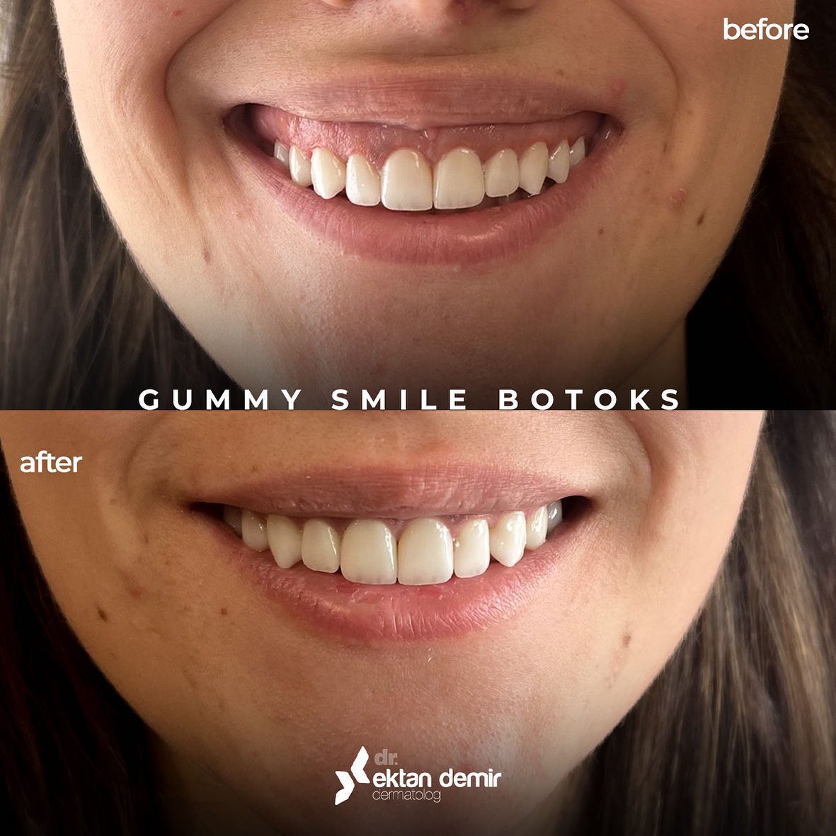 Konuşurken veya gülerken üst diş etlerinin gerektiğinden fazla görünmesi durumuna GUMMY SMILE denir ve kişilerde sosyal problem haline gelebilmektedir.
Ortalama 5dk süren işlem sonunda 4-6 ay boyunca bu problemin önüne geçmiş oluyoruz🤓ektandemir.com/botoks/

#botoks #gummysmile