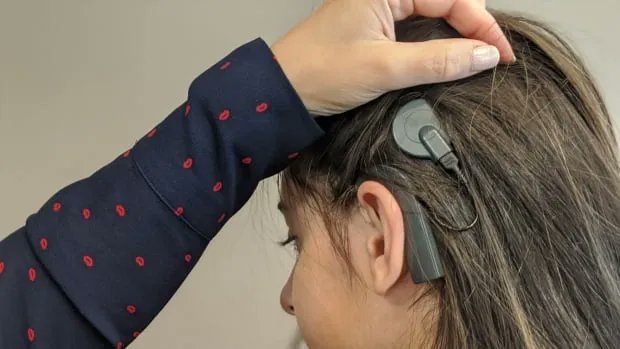 #Saskatchewan gov't will co-pay for cochlear implant device replacements effective Dec. 1  buff.ly/3s4iJ10 #cochlearimplants #Canada #CBC #hearingloss #hearingaids #deaf
