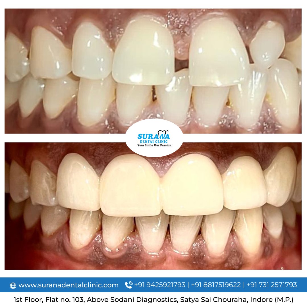 suranadental's tweet image. Smile designing completed for this beautiful lady with a gift of 💯% confidence.
.
.
#dentalcap #TeethShape #dentist #dentistry #smile #healthyteeth #dentalcare #strongteeth #tooth #suranadentalclinic #dentalclinic #indore #indoreposr #bestclinic #india