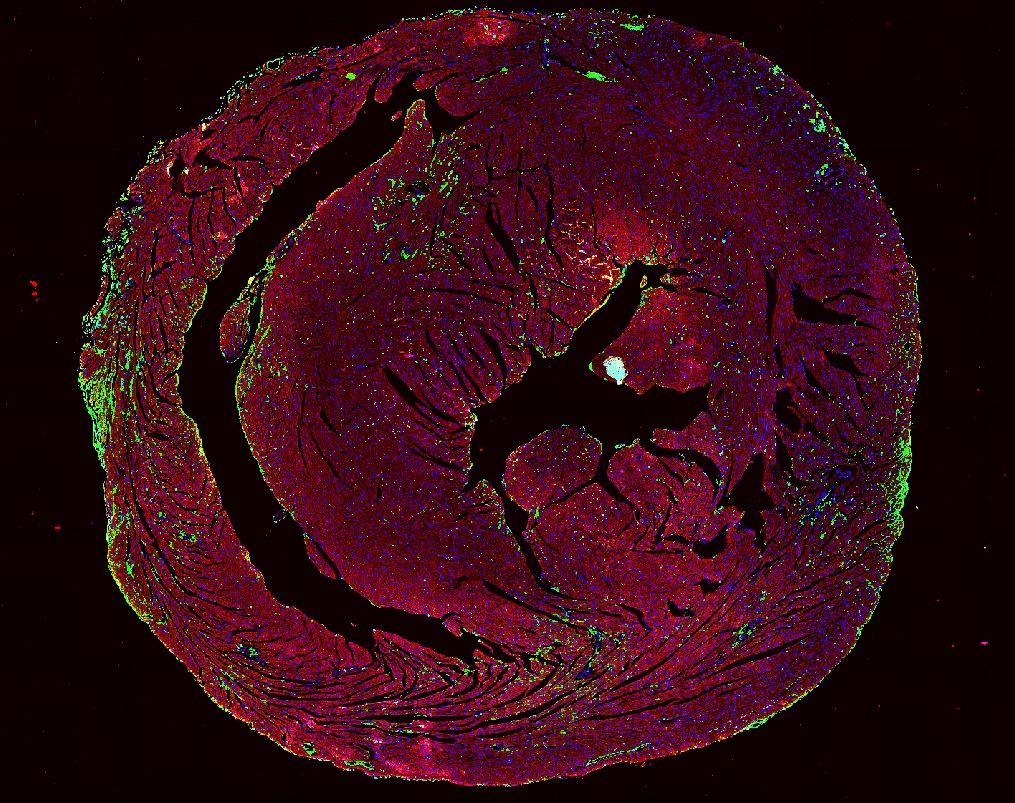 Breathtaking picture depicting ICI-myocarditis in collaboration w/ Drs. Lin &amp; Yang at <a href="/MDAndersonNews/">MD Anderson Cancer Center</a>! Green represents immune infiltrates in the heart. For the first time, we are beginning to understand why sex differences occur in myocarditis! #CardioOnc #CardioImmunology