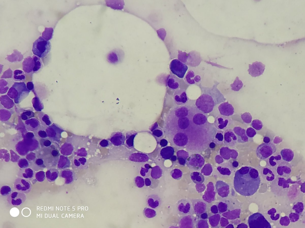 VTKrishna1's tweet photo. 73/M Pancytopenia, Type2 RF, Bronchiectasis, Acute Decompensated HF
#pathology #Hematology #pathtwitter https://t.co/nrxOXBMHX1