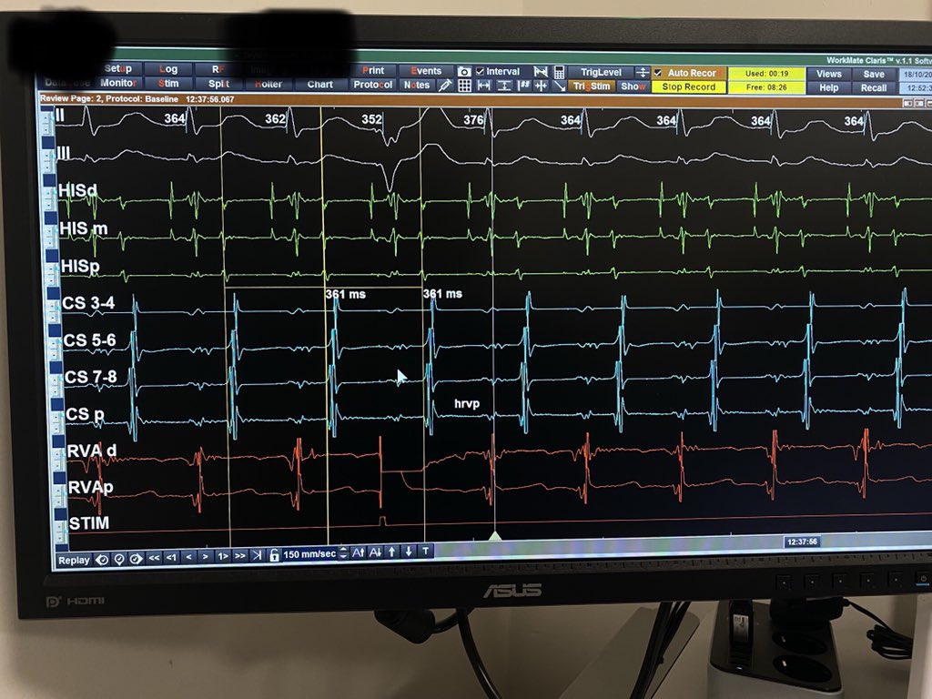 gokselcinier's tweet photo. Although I love fancy 3D images in #EPeeps, these basic SVT’s and differential maneuvers are gems. 

45y/f prior abl for LL AP twice. 

Referred to our clinic for the 3rd abl for parahisian AP. 

Thanks @MBassorkun for maneuvers

@taylanakgun @AEyupo @drbarutcu @Phiso_de https://t.co/mspyI7nLiU
