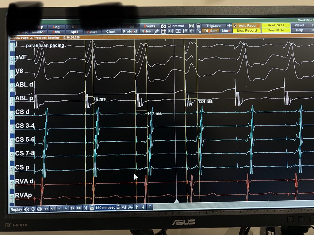 Göksel Çinier (@gokselcinier) on Twitter photo Although I love fancy 3D images in #EPeeps, these basic SVT’s and differential maneuvers are gems.
45y/f prior abl for LL AP twice.
Referred to our clinic for the 3rd abl for parahisian AP.
Thanks <a href="/MBassorkun/">Mustafa Bassorkun</a> for maneuvers
<a href="/taylanakgun/">Taylan Akgün</a> <a href="/AEyupo/">dreyupozkan</a> <a href="/drbarutcu/">Süleyman Barutçu</a> <a href="/Phiso_de/">Philipp Sommer</a> Although I love fancy 3D images in #EPeeps, these basic SVT’s and differential maneuvers are gems.
45y/f prior abl for LL AP twice.
Referred to our clinic for the 3rd abl for parahisian AP.
Thanks <a href="/MBassorkun/">Mustafa Bassorkun</a> for maneuvers
<a href="/taylanakgun/">Taylan Akgün</a> <a href="/AEyupo/">dreyupozkan</a> <a href="/drbarutcu/">Süleyman Barutçu</a> <a href="/Phiso_de/">Philipp Sommer</a>