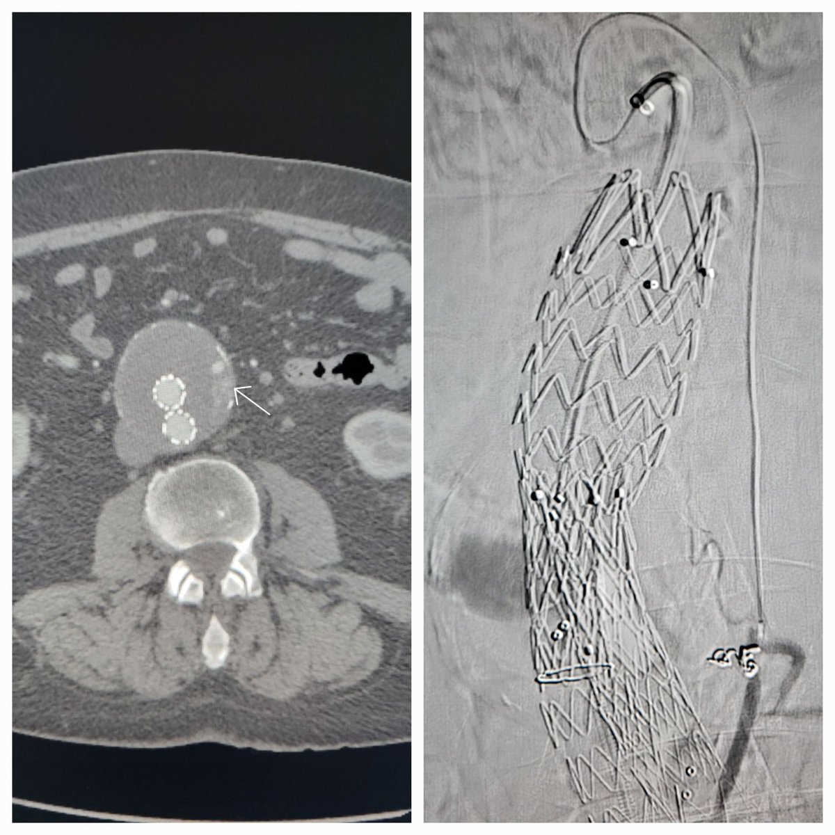 TempleRADs's tweet photo. Patient w/ AAA s/p EVAR and Type II endoleak. Initially treated w/ IMA embo. Presents 2 yrs later w/ persistent leak and growth. Translumbar embo targeted w/ Xper guide and filled w/ coils and glue. Cool case @chanrahan21 @MarkEdelsteinIR @SLee106 @TempleRadRes @SIRRFS @SIR_ECS https://t.co/eOOHL5NXan