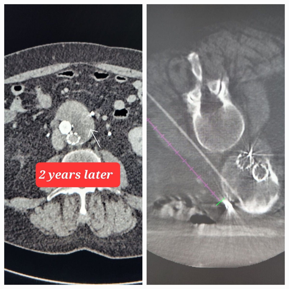 TempleRADs's tweet photo. Patient w/ AAA s/p EVAR and Type II endoleak. Initially treated w/ IMA embo. Presents 2 yrs later w/ persistent leak and growth. Translumbar embo targeted w/ Xper guide and filled w/ coils and glue. Cool case @chanrahan21 @MarkEdelsteinIR @SLee106 @TempleRadRes @SIRRFS @SIR_ECS https://t.co/eOOHL5NXan