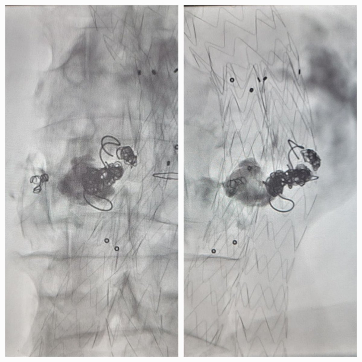 TempleRADs's tweet photo. Patient w/ AAA s/p EVAR and Type II endoleak. Initially treated w/ IMA embo. Presents 2 yrs later w/ persistent leak and growth. Translumbar embo targeted w/ Xper guide and filled w/ coils and glue. Cool case @chanrahan21 @MarkEdelsteinIR @SLee106 @TempleRadRes @SIRRFS @SIR_ECS https://t.co/eOOHL5NXan