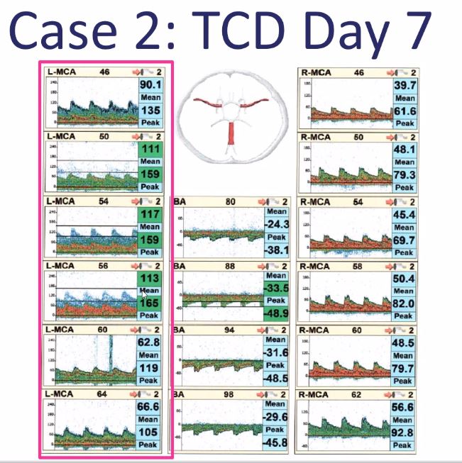 Ryan Hakimi shows use of #neuroultrasound in assessing LVO in AIS   <a href="/neurocritical/">Neurocritical Care Society</a> #TCD workshop
⛽️Persistent vessel asymmetry shows no recanalization
L MCA 90, R MCA 39.7 !!!
Is this phenotype good target for induced hypertension if no thrombectomy?
 <a href="/SCCM/">SCCM</a>  <a href="/asneuroimaging/">American Society of Neuroimaging</a>