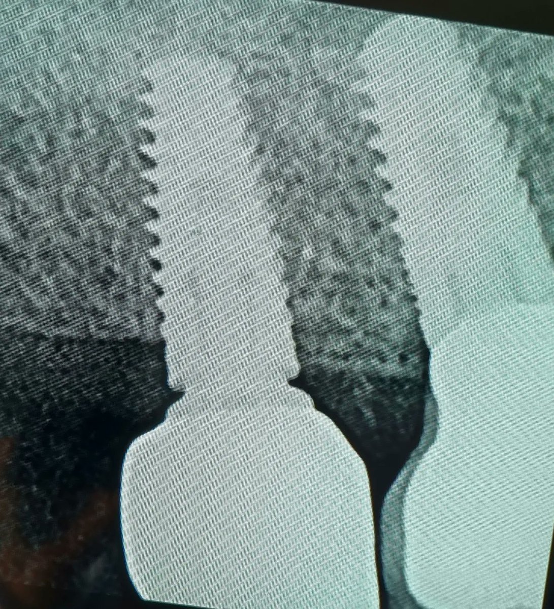 avendanodr's tweet photo. Daily Floss News 397 #mismeetteam, #MISImplants #C1, #perioimplant, #avendanodr
Cirugía y colocación de implante MIS C1, por Dr Adrián Avendaño y rehabilitacion protesica de implante, por Dr Rony Rivera https://t.co/S8zUfjHDXg